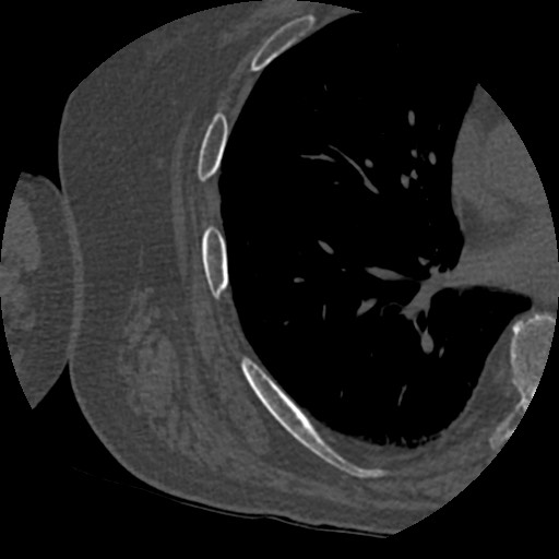 Anterior glenohumeral dislocation with Hill-Sachs lesion (Radiopaedia 62877-71249 Axial bone window 110).jpg