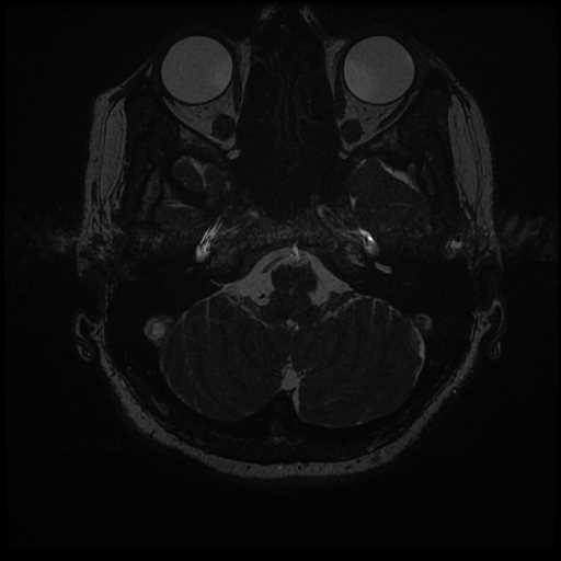 Anterior inferior cerebellar artery vascular loop - type II (Radiopaedia 70991-81209 Axial 3D FIESTA 58).jpg