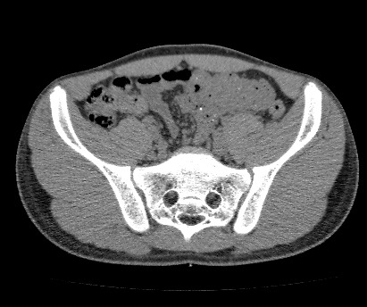 Anterior inferior iliac spine avulsion fracture (Radiopaedia 81312-94999 Axial non-contrast 29).jpg