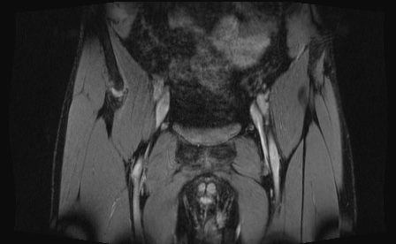 Anterior inferior iliac spine avulsion fracture (Radiopaedia 81312-95000 G 87).jpg