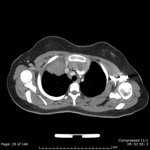 Anterior mediastinal B cell Lymphoma (Radiopaedia 50677-56114 A 15).jpg