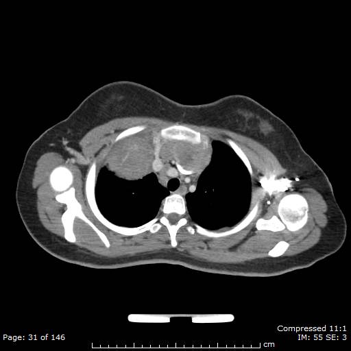 Anterior mediastinal B cell Lymphoma (Radiopaedia 50677-56114 A 16).jpg