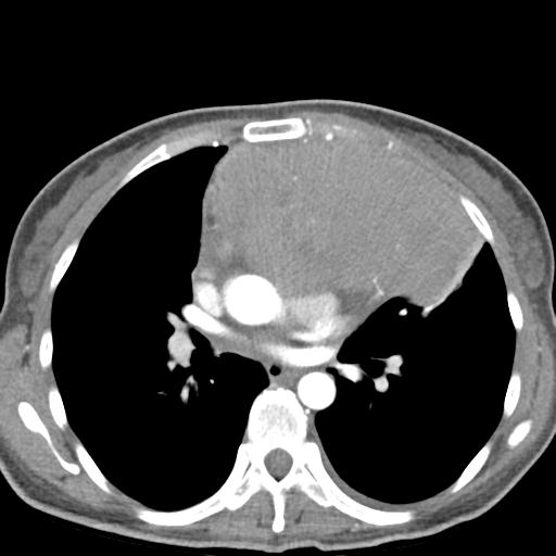 File:Anterior mediastinal lymphoma (Radiopaedia 29556-30061 C 28).jpg