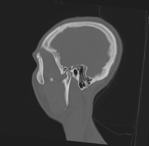 File:Anterior nasal spine fracture (Radiopaedia 46138-50494 Sagittal bone window 12).png