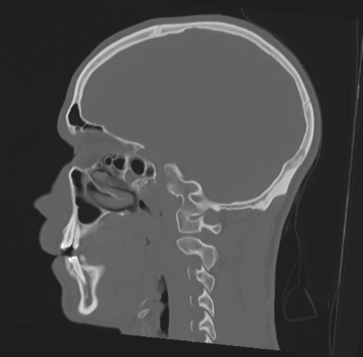 Anterior nasal spine fracture (Radiopaedia 46138-50494 Sagittal bone window 34).png