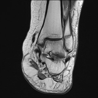 File:Anterior talofibular ligament injury - rupture with soft-tissue impingement (Radiopaedia 38765-40928 Coronal PD 16).jpg