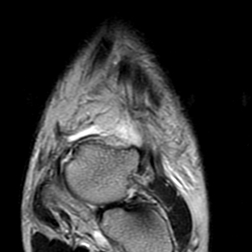 File:Anterior talofibular ligament rupture (Radiopaedia 15831-15484 Coronal T2 4).jpg