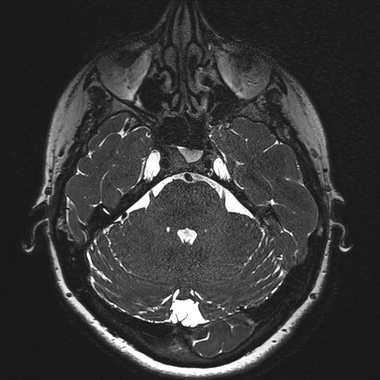 Anterior temporal encephalocele (Radiopaedia 82624-96808 Axial T2 high res 36).jpg