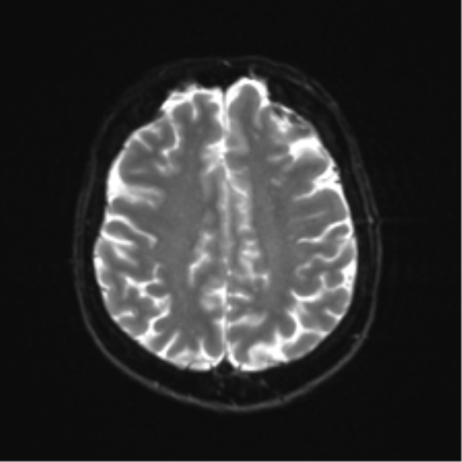 Anterior temporal lobe perivascular space (Radiopaedia 40946-43650 Axial DWI 20).png