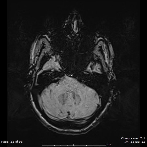 File:Anterior temporal lobe perivascular space (Radiopaedia 88283-104914 Axial SWI 2).jpg