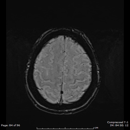 Anterior temporal lobe perivascular space (Radiopaedia 88283-104914 Axial SWI 53).jpg