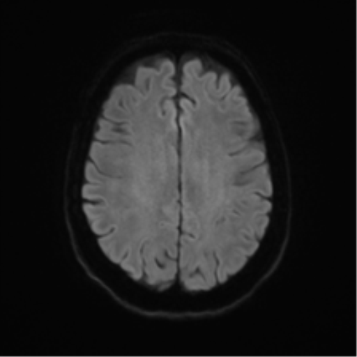 Anterior temporal pole cysts (Radiopaedia 46629-51102 Axial DWI 46).png