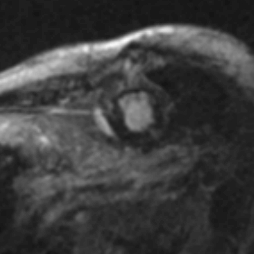 File:Anteroseptal hypokinesia after myocardial infarction (Radiopaedia 15978-15633 I 6).jpg