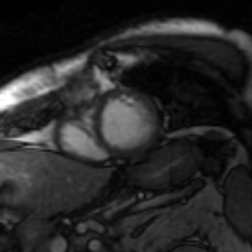 File:Anteroseptal hypokinesia after myocardial infarction (Radiopaedia 15978-15633 Short axis SSFE 2).jpg