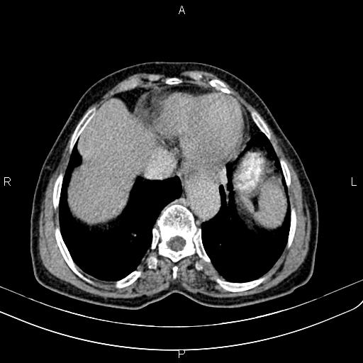 Aortic aneurysm and Lemmel syndrome (Radiopaedia 86499-102554 Axial C+ delayed 8).jpg