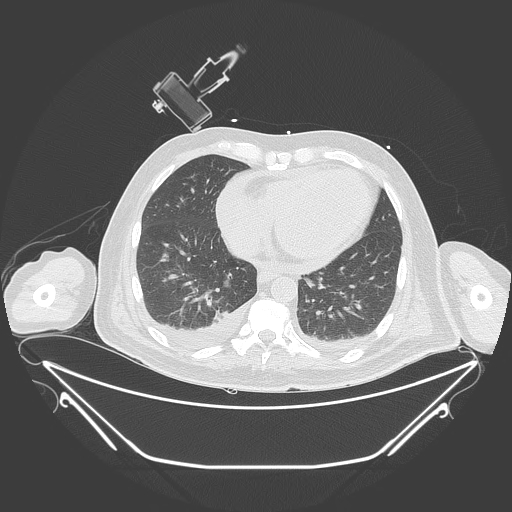 Aortic arch aneurysm (Radiopaedia 84109-99365 Axial lung window 197).jpg