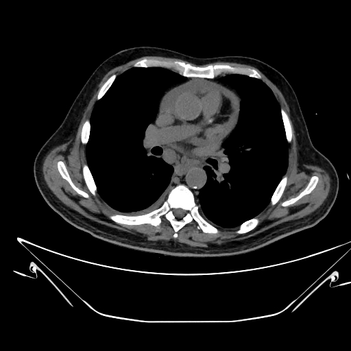 Aortic arch aneurysm (Radiopaedia 84109-99365 Axial non-contrast 138).jpg