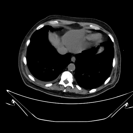 Aortic arch aneurysm (Radiopaedia 84109-99365 Axial non-contrast 224).jpg