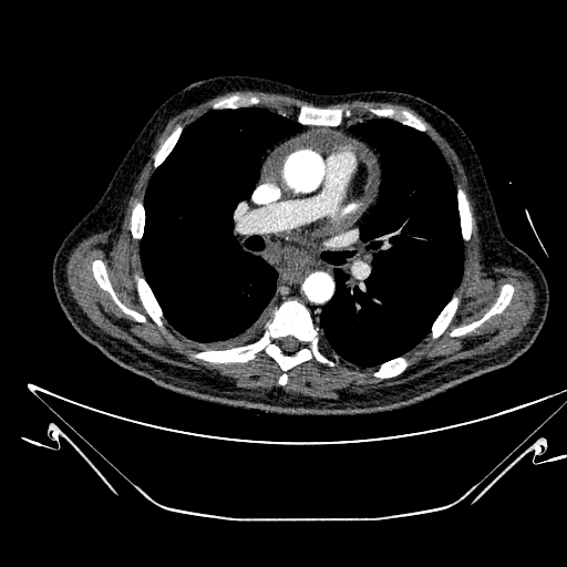 Aortic arch aneurysm (Radiopaedia 84109-99365 B 300).jpg