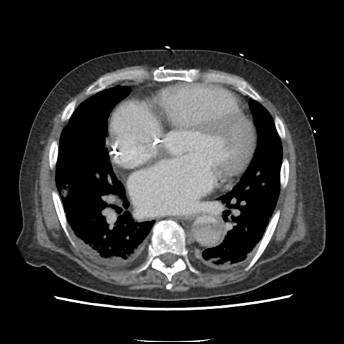 Aortic arch graft infection (FDG PET-CT) (Radiopaedia 71975-82437 A 35).jpg