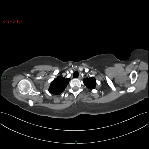 File:Aortic arch origin of left vertebral artery (Radiopaedia 51520-57286 A 28).jpg