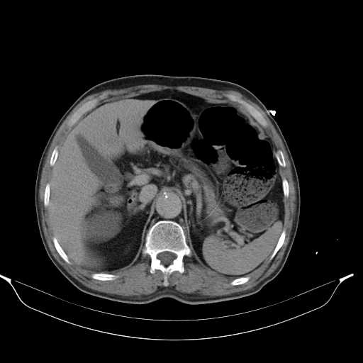 File:Aortic dissection- Stanford type A (Radiopaedia 22085-22085 Axial C+ delayed 14).jpg