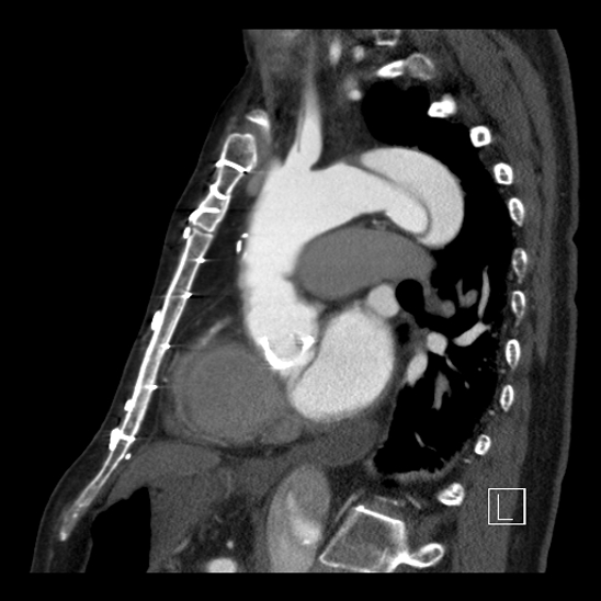 Aortic dissection (CTPA) (Radiopaedia 75506-86750 C 62).jpg