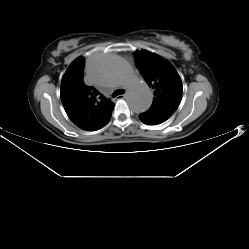 File:Aortic dissection (Radiopaedia 25350-25604 B 17).jpg