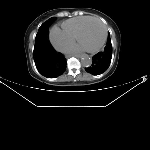 File:Aortic dissection (Radiopaedia 25350-25604 B 32).jpg