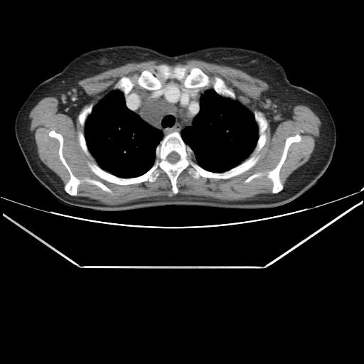 File:Aortic dissection (Radiopaedia 25350-25604 C 8).jpg