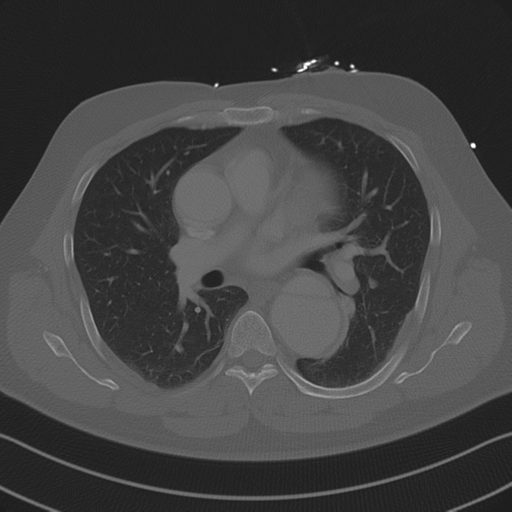 File:Aortic dissection (Radiopaedia 50763-56234 Axial bone window 52).png