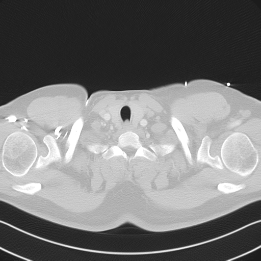 File:Aortic dissection (Radiopaedia 50763-56234 Axial lung window 8).png