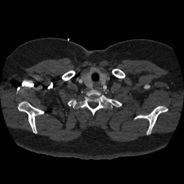 Aortic dissection (Radiopaedia 57969-64959 A 23).jpg
