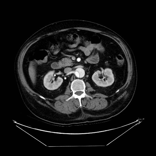 Aortic dissection (Radiopaedia 62562-71000 A 62).jpg
