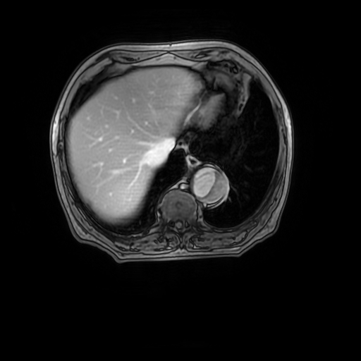 File:Aortic dissection - Stanford A - DeBakey I (Radiopaedia 23469-23551 Axial MRA 31).jpg