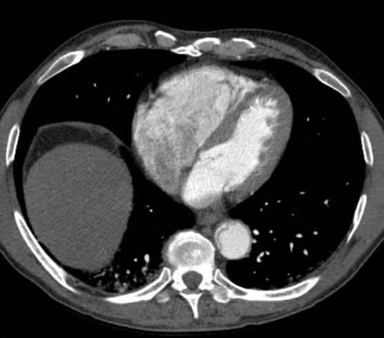 File:Aortic dissection - Stanford type B (Radiopaedia 73648-84437 A 78).jpg