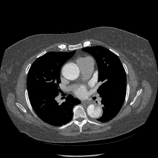 Aortic dissection - Stanford type B (Radiopaedia 88281-104910 A 42).jpg