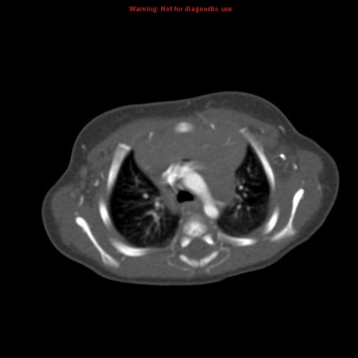 Aortic ductus diverticulum (Radiopaedia 8339-9180 A 24).jpg