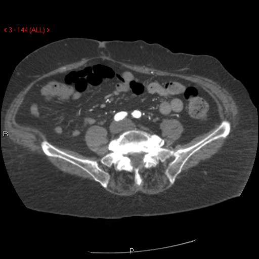 Aortic intramural hematoma (Radiopaedia 27746-28001 A 144).jpg