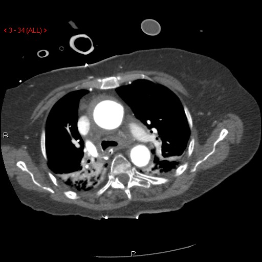 File:Aortic intramural hematoma (Radiopaedia 27746-28001 A 34).jpg