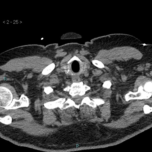 Aortic intramural hematoma (Radiopaedia 48463-53380 Axial non-contrast 11).jpg