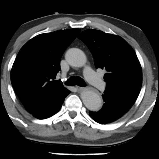 Aortic intramural hematoma (type B) (Radiopaedia 79323-92387 Axial C+ delayed 19).jpg