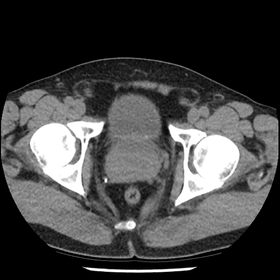 Aortic intramural hematoma (type B) (Radiopaedia 79323-92387 Axial non-contrast 111).jpg