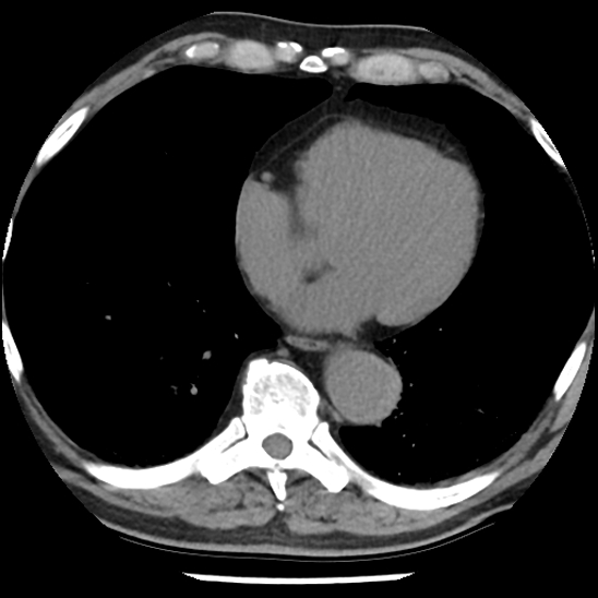 Aortic intramural hematoma (type B) (Radiopaedia 79323-92387 Axial non-contrast 36).jpg