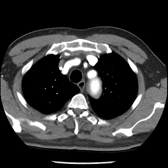 Aortic intramural hematoma (type B) (Radiopaedia 79323-92387 B 9).jpg