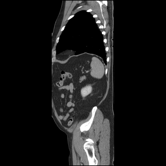 Aortic intramural hematoma (type B) (Radiopaedia 79323-92387 Sagittal C+ delayed 47).jpg