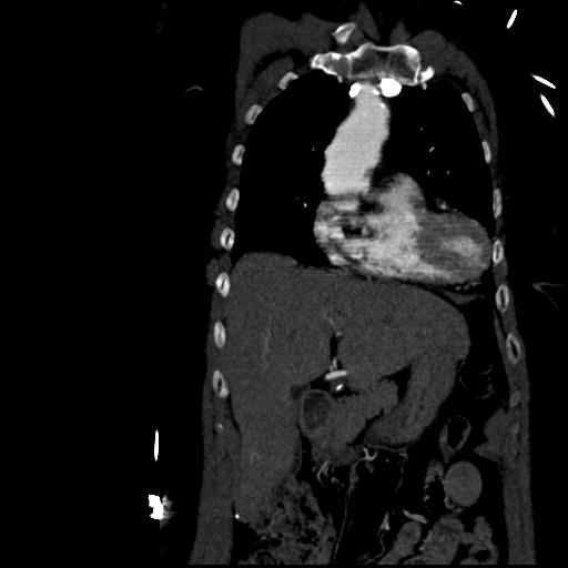 Aortic intramural hematoma from penetrating atherosclerotic ulcer (Radiopaedia 31137-31836 C 16).jpg