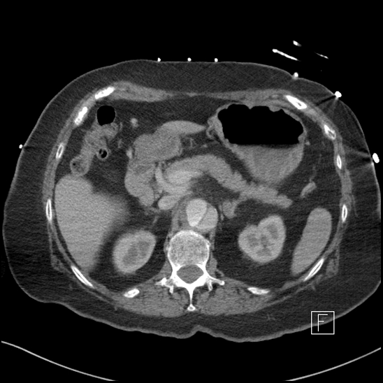 Aortic intramural hematoma with dissection and intramural blood pool (Radiopaedia 77373-89491 E 16).jpg