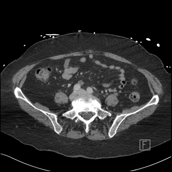 Aortic intramural hematoma with dissection and intramural blood pool (Radiopaedia 77373-89491 E 64).jpg