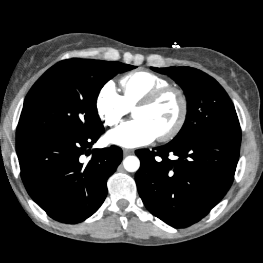 File:Aortic valve non-coronary cusp thrombus (Radiopaedia 55661-62189 A 39).png
